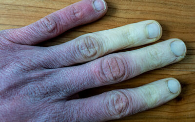 Icy cold, numb fingers this winter – could it be Raynaud’s?