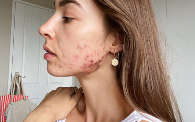 Living with acne