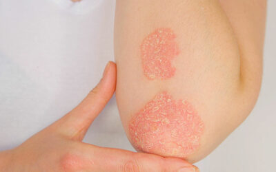 Psoriasis
