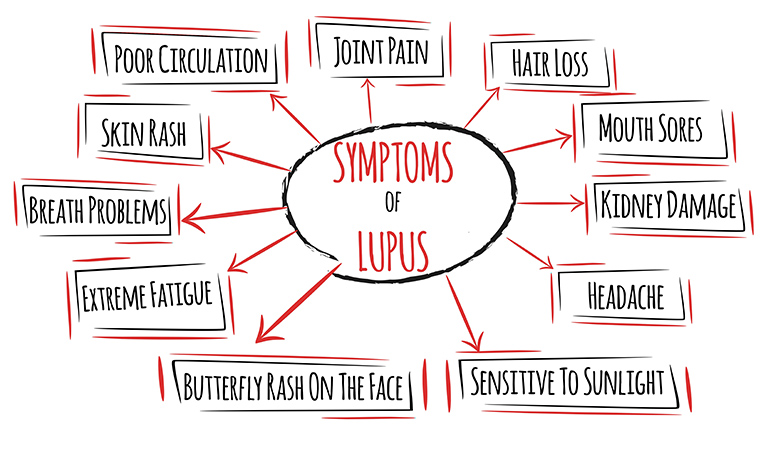 What-are-the-typical-symptoms-of-lupus