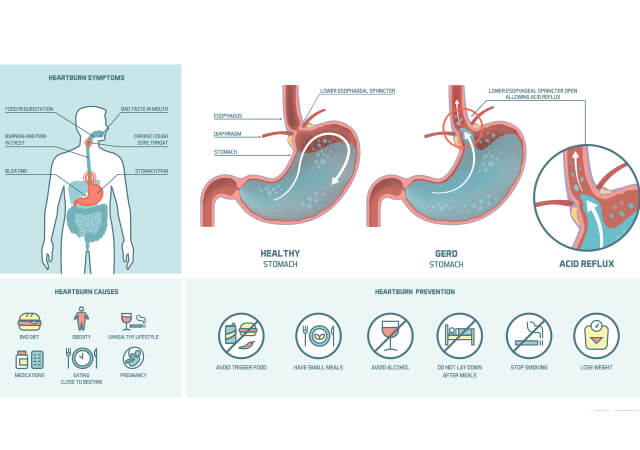 Acid Reflux