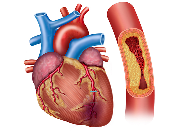 Coronary artery disease