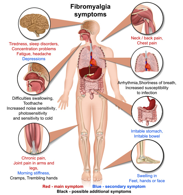 Fibromyalgia has many associated symptoms besides the pain. They include fatigue, difficulty concentrating and thinking clearly, headaches and sleep disturbances.