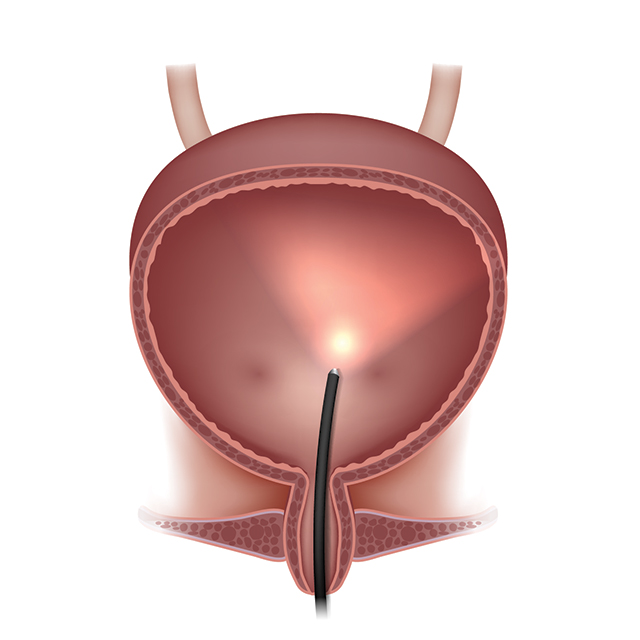 How is interstitial cystitis diagnosed