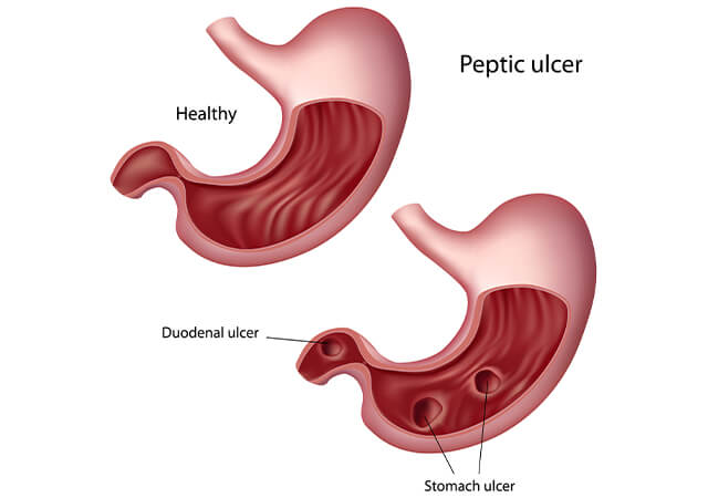 Peptic Ulcer in Stomach