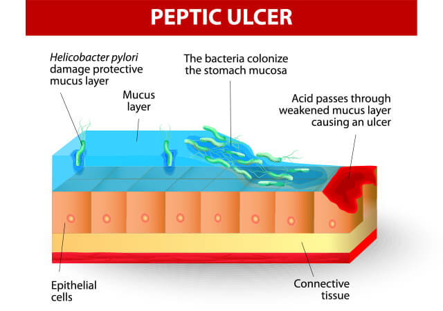 Peptic Ulcer
