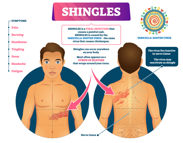 What causes shingles to reactivate?