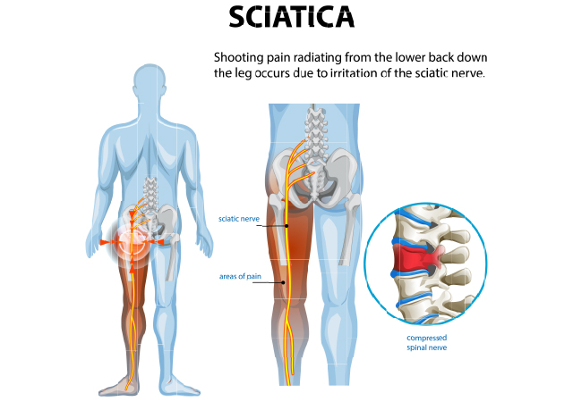 What causes sciatica?