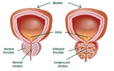 The prostate